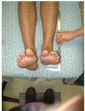 הבדל באורך רגליים - טיפול ואבחנה