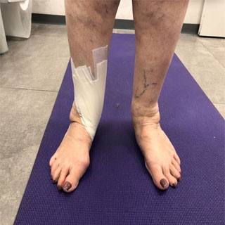 Tibialis Posterior Dysfunction - טיפול