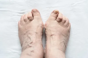 אבחון וטיפול אצבע פטיש במרכז איימקס